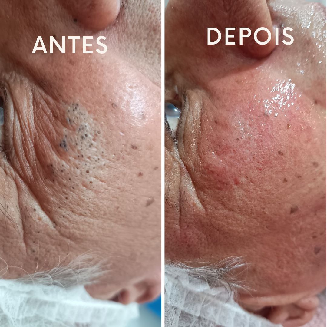 Limpeza de Pele 4