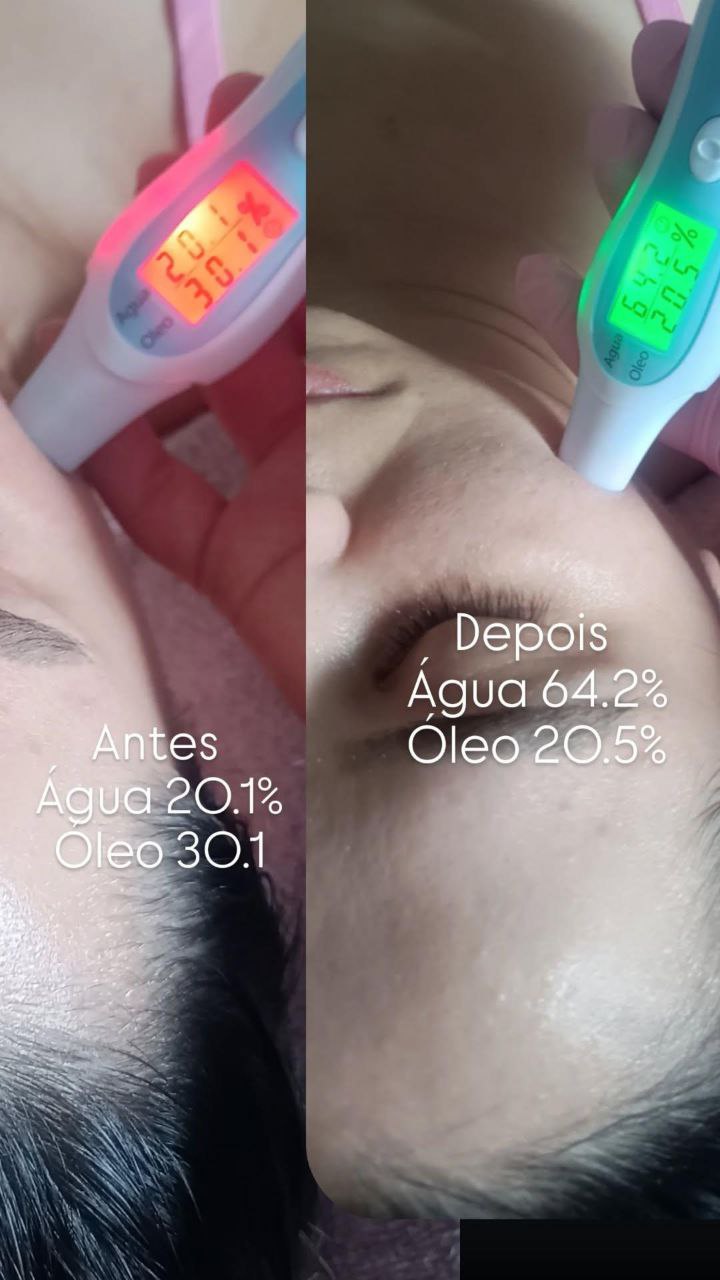 Limpeza de Pele 5